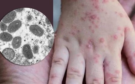 Viruela del mono estaria en Honduras, hay sospechosos